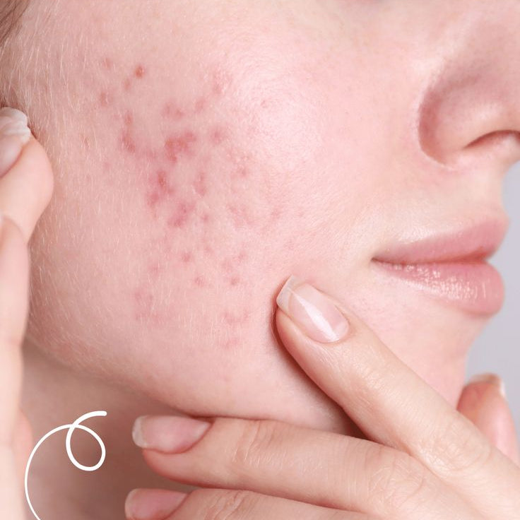 Person with acne on face with text overlay about natural remedies for acne, and a call to action to learn more at beoty.com.