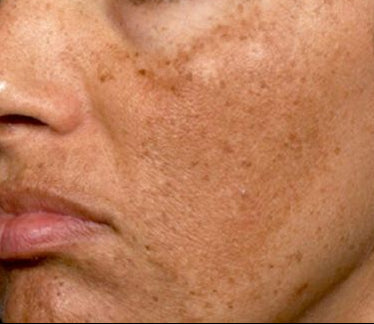 Close-up of a woman's face with freckles and brown eyes.